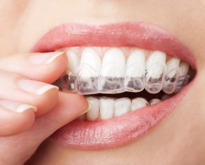 Invisalign for the Holidays Bellevue WA