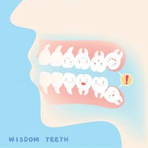 Wisdom Teeth Bellevue WA